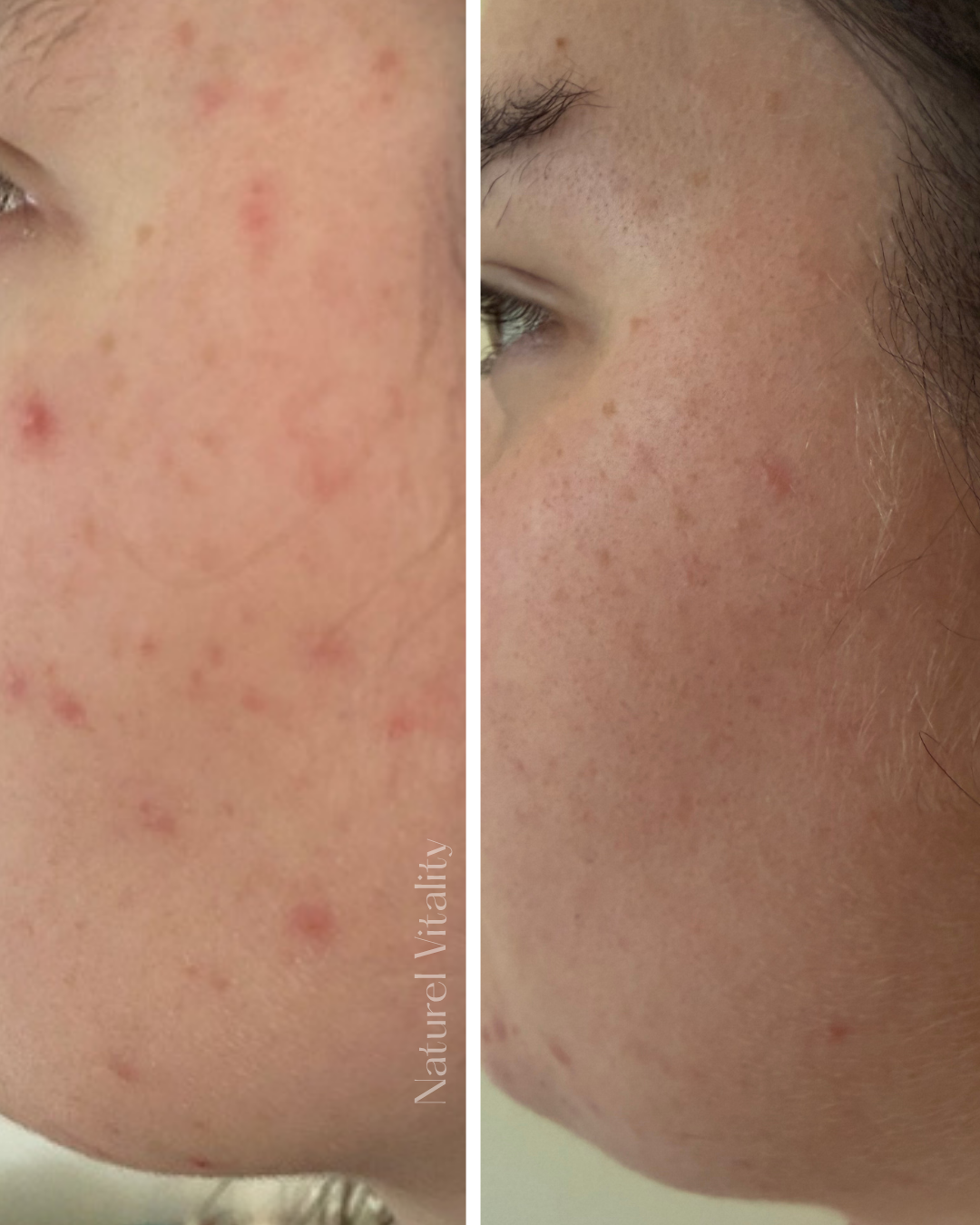 before and after acne